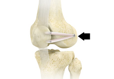 Patellofemoral Stabilization