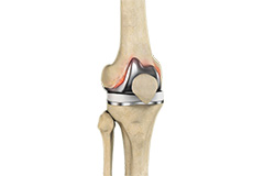 Periprosthetic Knee Fractures