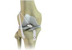 Physeal Sparing Reconstruction of the Anterior Cruciate Ligament