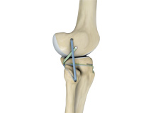 Posterolateral Corner (PLC) Reconstruction