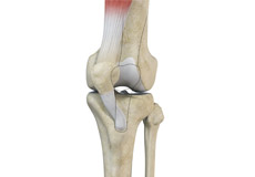 Recurrent Patella Dislocation