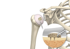 Shoulder Preservation Surgery