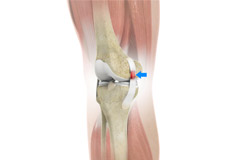 Sprains and Strains