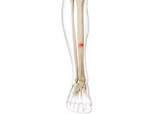 Stress Fracture of the Tibia