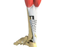Tendon Repair Surgery