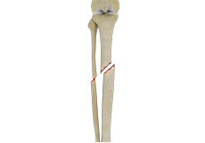 Tibial Shaft Fracture