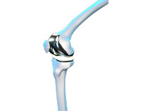 What is New in Knee Replacement