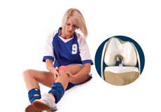 Women and ACL Injuries