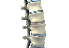 Anterior Lumbar Interbody Fusion