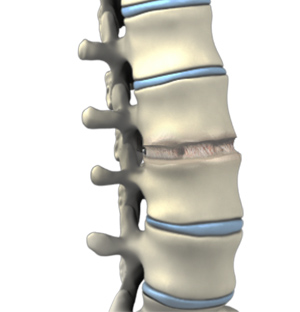 Anterior Lumbar Interbody Fusion