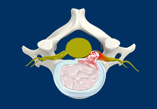 Cervical Disc Herniation