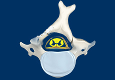 Cervical Laminectomy