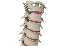 Cervical Spondylosis