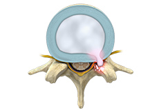 Degenerative Disc Disease