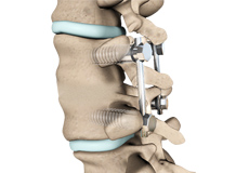 Lumbar Fusion