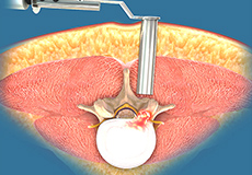 Minimally Invasive Lumbar Surgery