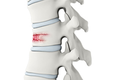 Spinal Fractures