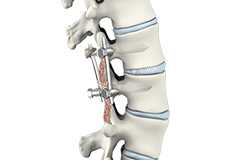Spinal Fusion