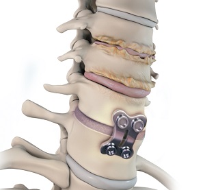 Adjacent Segment Disc Disease