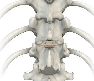 Direct Lateral Interbody Fusion (DLIF)