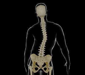 Idiopathic Scoliosis