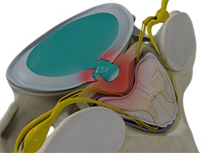 Spinal Disorders