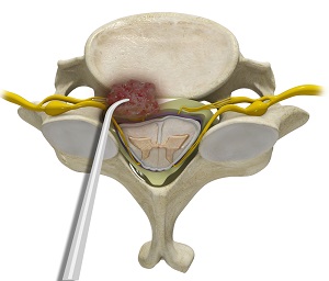 Tumour Decompression
