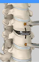 Cervical Disc Replacement