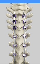 Spine Deformity Surgery