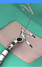 Minimally Invasive Spine Surgery