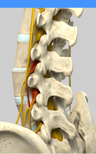 Outpatient Spine Surgery