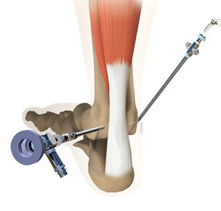 Ankle Arthroscopy