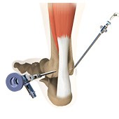 Ankle Arthroscopy