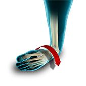 Ankle Instability Surgery