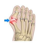 Bunion