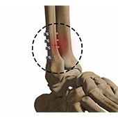 Complex Foot and Ankle Surgeries