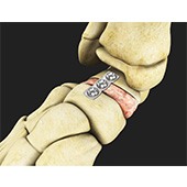 Flatfoot Reconstruction