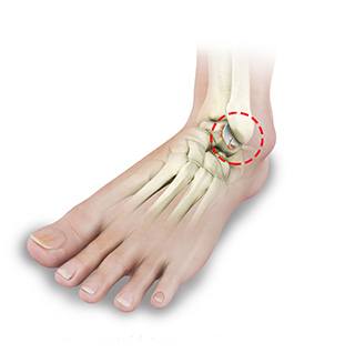Foot and Ankle Arthritis