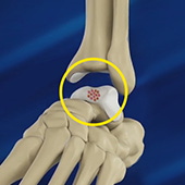Foot and Ankle Cartilage Repair