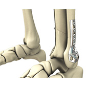 Open Reduction and Internal Fixation of the Ankle