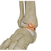 Osteochondral Lesions of the Ankle
