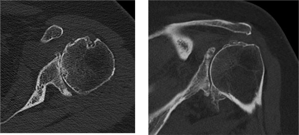 axial CT slices showing posterior glenoid wear and retroversion in glenohumeral osteoarthritis before shoulder replacement