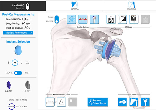 computer navigated preoperative plan for a stemless total shoulder replacement shown on a three dimensional model of the patient's scapula and humerus