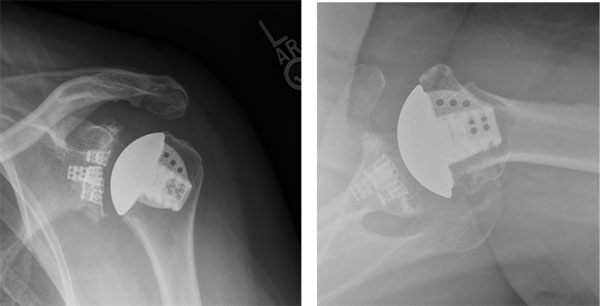 post-operative AP and axillary x-rays showing a stemless anatomic total shoulder replacement placed using computer navigation
