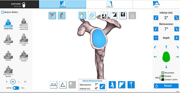 computer navigated plan showing a glenoid component positioned on a three dimensional model of the scapula with 99 percent bone contact