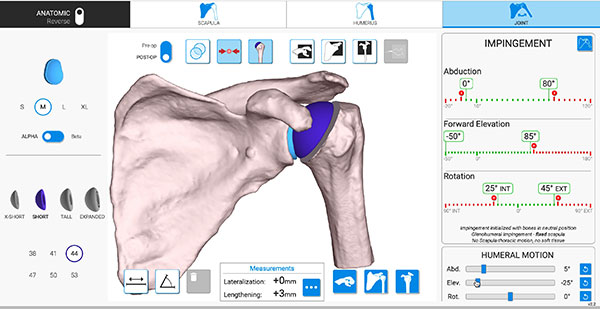 computer navigated plan showing an assembled shoulder joint with simulated range of motion and impingement analysis after total shoulder replacement