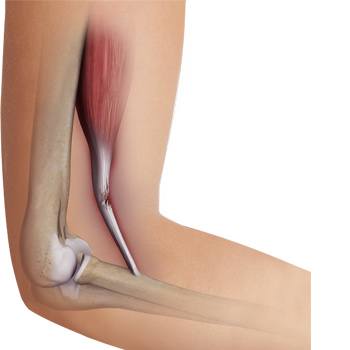 Bicep Tendon Tear at the Elbow