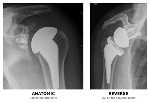 side by side x-ray comparison of anatomic and reverse total shoulder replacement showing the reversed ball and socket positions