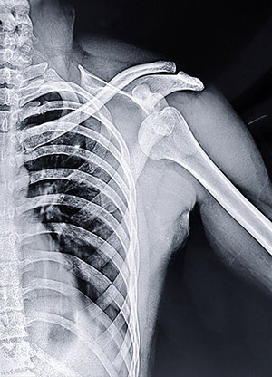 x-ray of an anterior shoulder dislocation showing the humeral head displaced downward and medially out of the glenoid