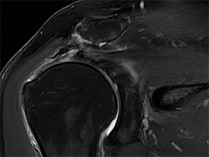 MRI showing a full thickness supraspinatus tear with the tendon retracted to the mid humeral head